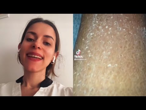 Cómo combatir la sequedad extrema en la piel