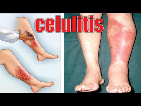 Cómo tratar la celulitis infecciosa en las piernas